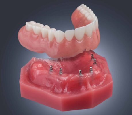 Replacing Missing Teeth in Tampa, FL | Mini Implants | Dr. Cabrera