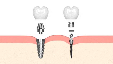 Implantes Dentales en Tampa, FL Tampa Mini Dental Implant Solutions