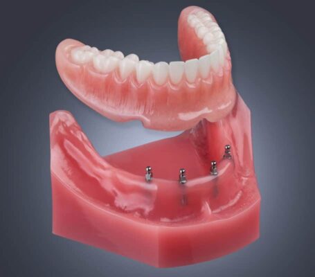 Dentaduras en Tampa, FL Tampa Bay Mini Dental Implant Solutions