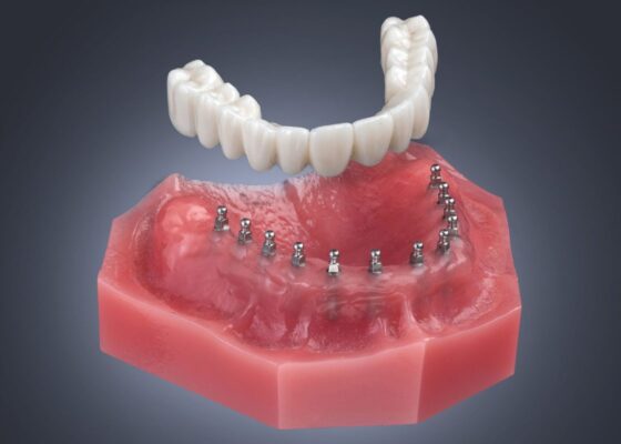 Implantes dentales All-on-6 en Tampa-FL-Luz-Cabrera-DMD