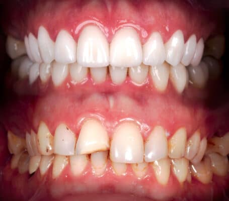Odontología Restauradora Tampa Bay Mini Implante Dental Soluciones