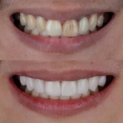 Smile Makeover Tampa Bay Mini Implante Dental Soluciones