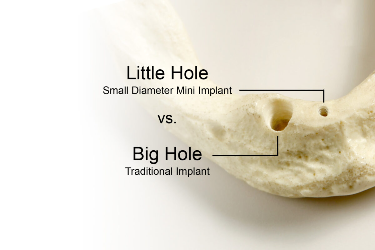 Alternativa ClearChoice en Tampa, FL | Beneficios de los Mini Implantes Dentales